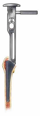 Echo Femoral Hip System 2.5 cm Figure 7 Figure 8 Reaming the Distal Femur Note: Fully toothed broaches are recommended with the Echo fracture system.