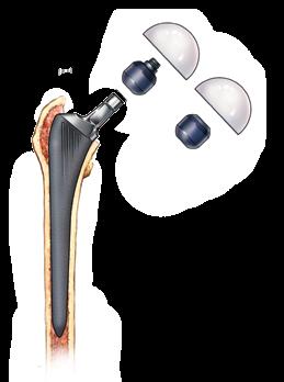 Endo II Trial Head RingLoc Bi-Polar Trial Head Figure 13 Figure 14 Echo FX Cemented Stem Insertion Select the Echo FX stem that is a minimum of 2 mm smaller than the final reamer and Exact Alliance