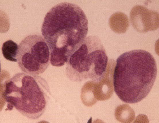 blood cell count - may progress to AML Myelodysplastic