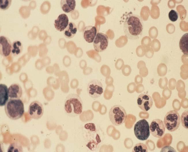 may progress to AML Acute myeloid leukemia (AML) - enhanced