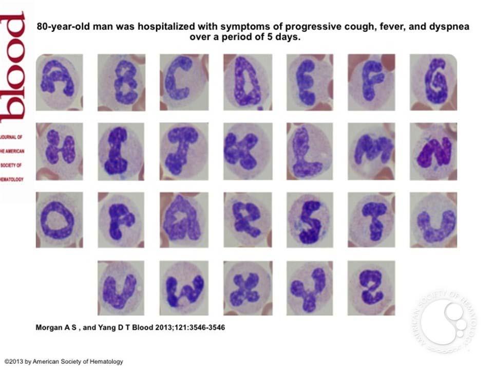 Case 1 - Differential 86% Neutrophils 12% Immature Granulocytes 2%