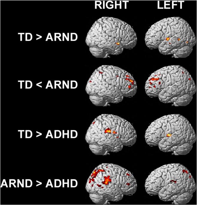 Malisza et al. Journal of Neurodevelopmental Disorders 2012, 4:12 Page 11 of 20 Table 5 Regions activated by the ADHD group during working memory (P > 0.