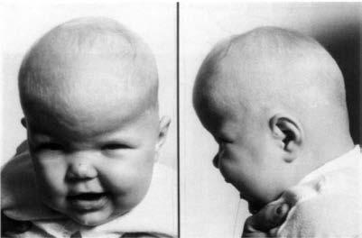 17. The young child in the image on the right displays a developmental abnormality. What is the general name for this type of developmental defect? (2.