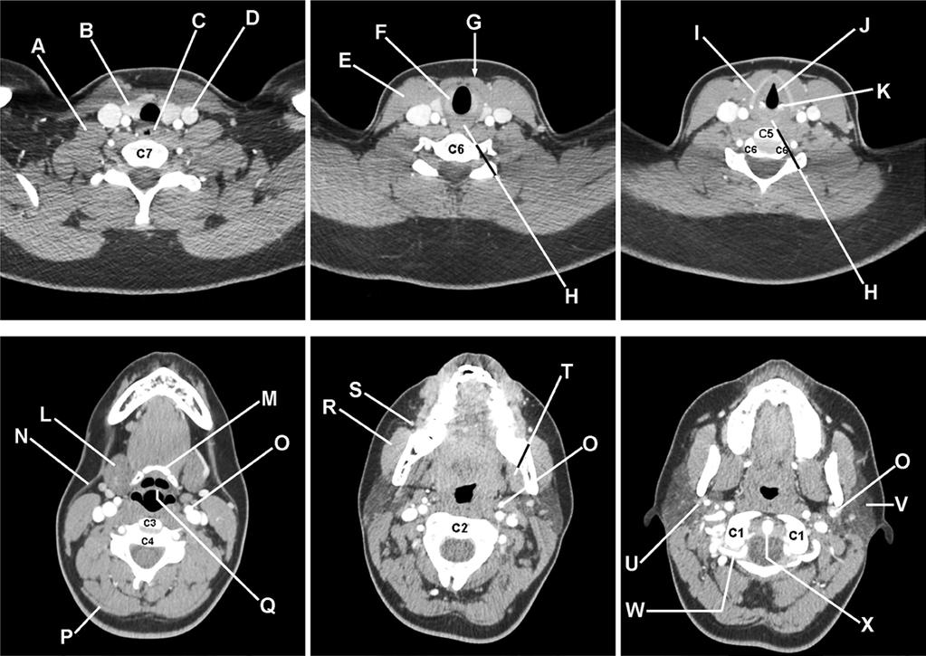 22. Presented below is a series of six axial CT images of the neck and head with intravascular contrast.