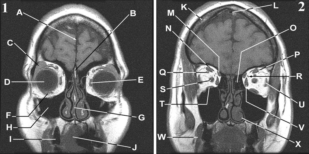 23. Presented below are two coronal T1 MRIs of the head.