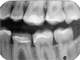 Caries Overhanging Restorations Open Contacts Calculus Moderate to Severe Marginal Periodontitis Evaluation and Follow-up of Treatment Caries Calculus Root Resorption Bone loss to apex!