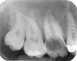 Severe Marginal Periodontitis Vertical Bone Loss! Usually localized to one or two teeth. May be several areas of vertical bone loss throughout the mouth! Two general types: 1. Interproximal crater 1.