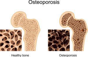 Osteoporosis Continued