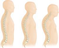 weaken from osteoporosis progression Too much