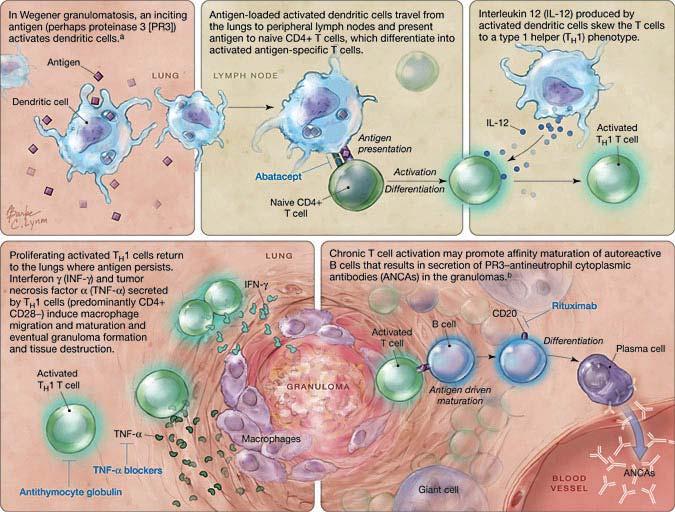 Model of Pathogenesis of Granulomatous Inflammation in WG Therapeutic Immune