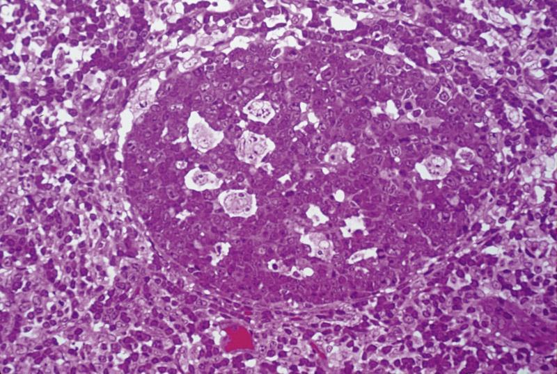 The inner region of the nodule shows a less stained area called germinal center, which contains activated lymphocytes, with pale