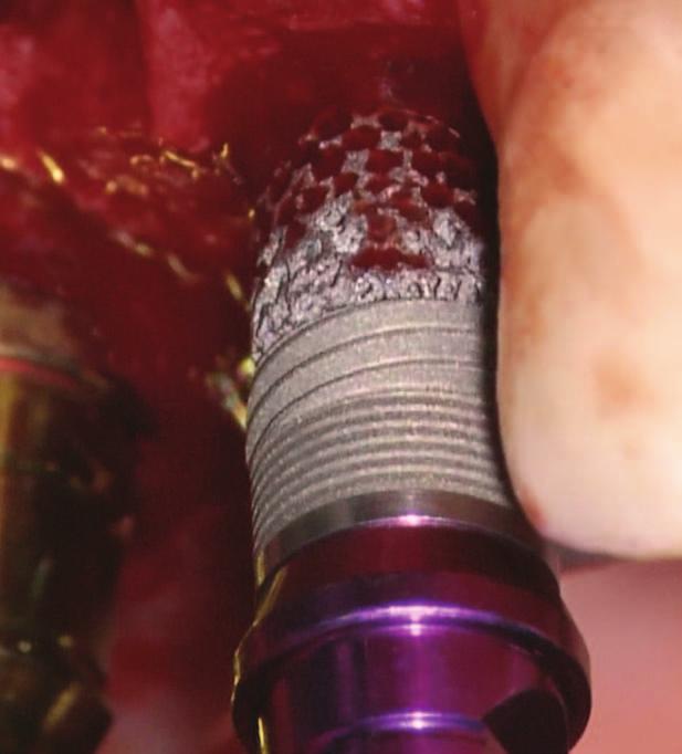 in human dental applications. Trabecular Metal Dental Implant placed in the maxilla and immediately loaded.