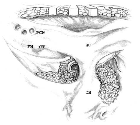 al 8 CWU 257 36 CWD 176 4 Figure 4. Epitympanic cholesteatoma in the left ear.