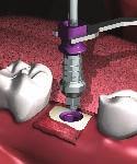 INTERNAL HEX IMPLANT PLACEMENT PROTOCOL SINGLE-STAGE HEALING OPTION Step 1 - Healing Abutment Using one of
