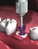1 2 Step 2 - Closing Tissue Suture the tissue around the healing abutment using standard surgical protocols.