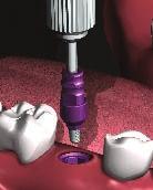 29 INTERNAL HEX IMPLANT PROSTHETIC PROTOCOL IMPLANT LEVEL IMPRESSION TECHNIQUE - CLOSED TRAY Step 1 - Removing the Healing Abutment or Cover Screw Using one of the 1.