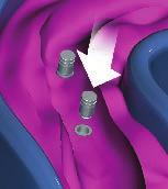 25mm hex drivers, remove the healing abutment or cover screw from the implant.