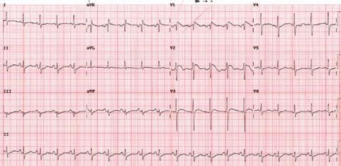 Brugada syndrome Fig 2. The 12-lead ECG showing Brugada ECG pattern. ECG = electrocardiography.
