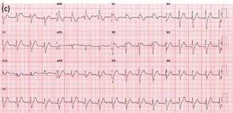 (b) The rhythm strip from the monitor showing ventricular fibrillation post flecainide loading.