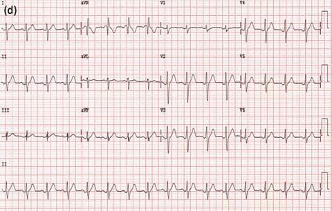(d) Repeat 12-lead ECG 3 hours later showing no feature suggestive of Brugada syndrome. ECG = electrocardiography.