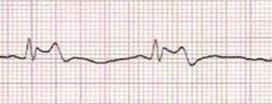 > Patients with Brugada syndrome are prone to develop ventricular tachyarrhythmias that may lead to syncope, cardiac arrest, or sudden cardiac death. > Diagnosis is based on clinical findings.