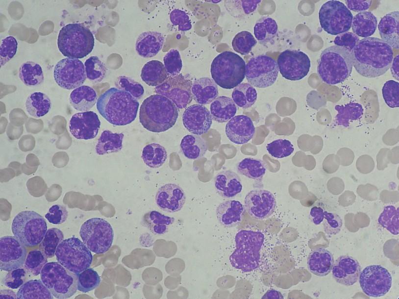 Abnormal neutrophils 62 year old presented with fatigue and lightheadedness.