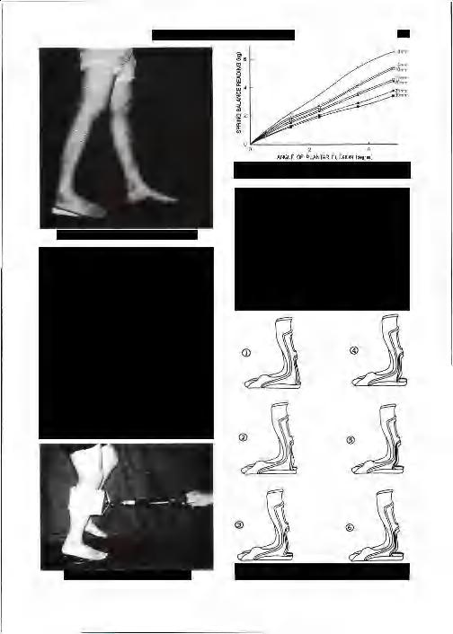 New plastic ankle foot orthosis for spastic leg 105 Fig. 4. Dorsiflexion moment in relation to plantar flexion for different trim lines. Fig. 2. Measuring of the amount of heel lift.
