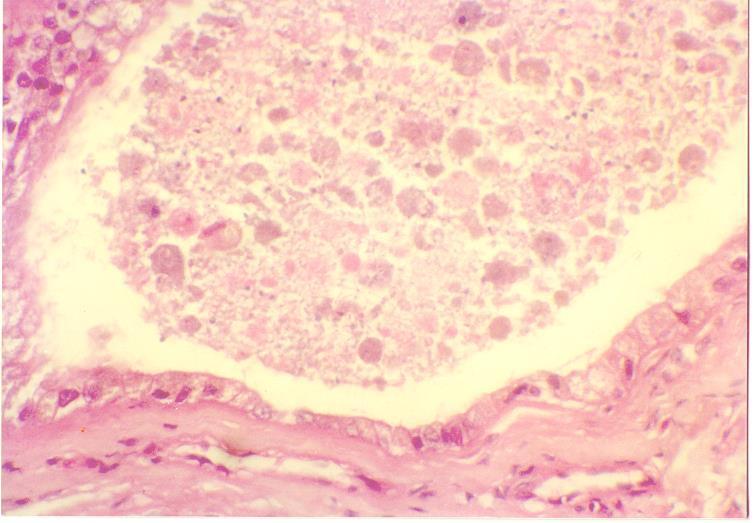 Epididymis showing dilated ducts with