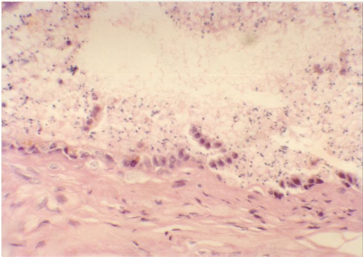 Epididymis of a patient showing sperm