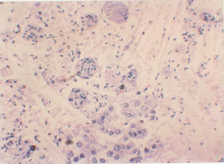 Dilated epididymal ducts contents showing macrophages with