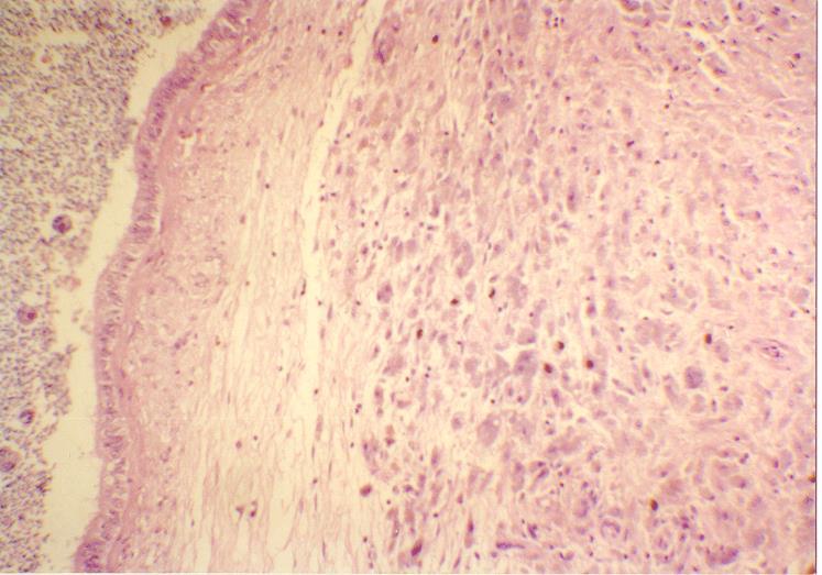 Epididymis showing interstitial collection of