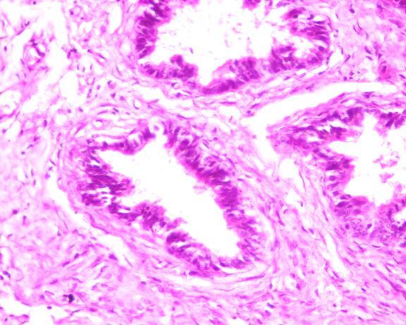 Interstitial epididymal fibrosis