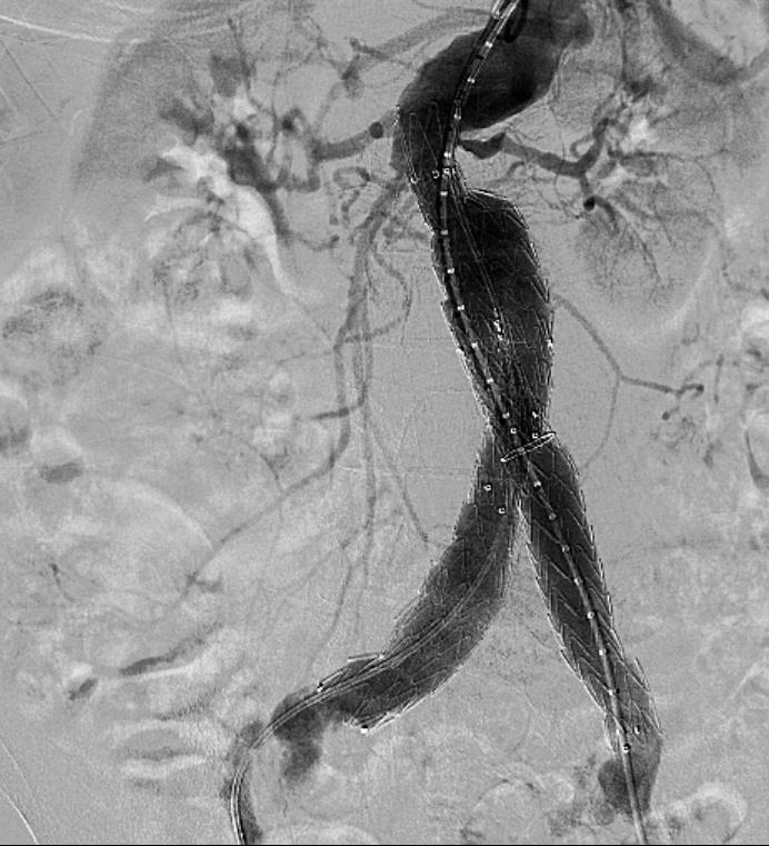 Case Example Initial Films Acute Infrarenal Angle/Suprarenal Angle Fairly Long Neck Within the Angulated Segment Endurant IIs Deployed Below