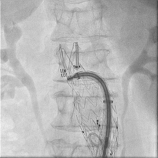 Case Example Initial Films Acute Infrarenal Angle/Suprarenal Angle Fairly Long Neck Within the Angulated Segment Endurant IIs Deployed Below the Renals Could Not