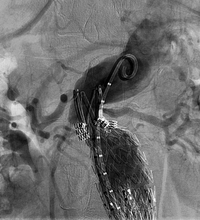 Case Example Initial Films Acute Infrarenal Angle/Suprarenal Angle Fairly Long Neck Within the Angulated Segment Endurant IIs Deployed Below the Renals Could Not Gain More Height Flared