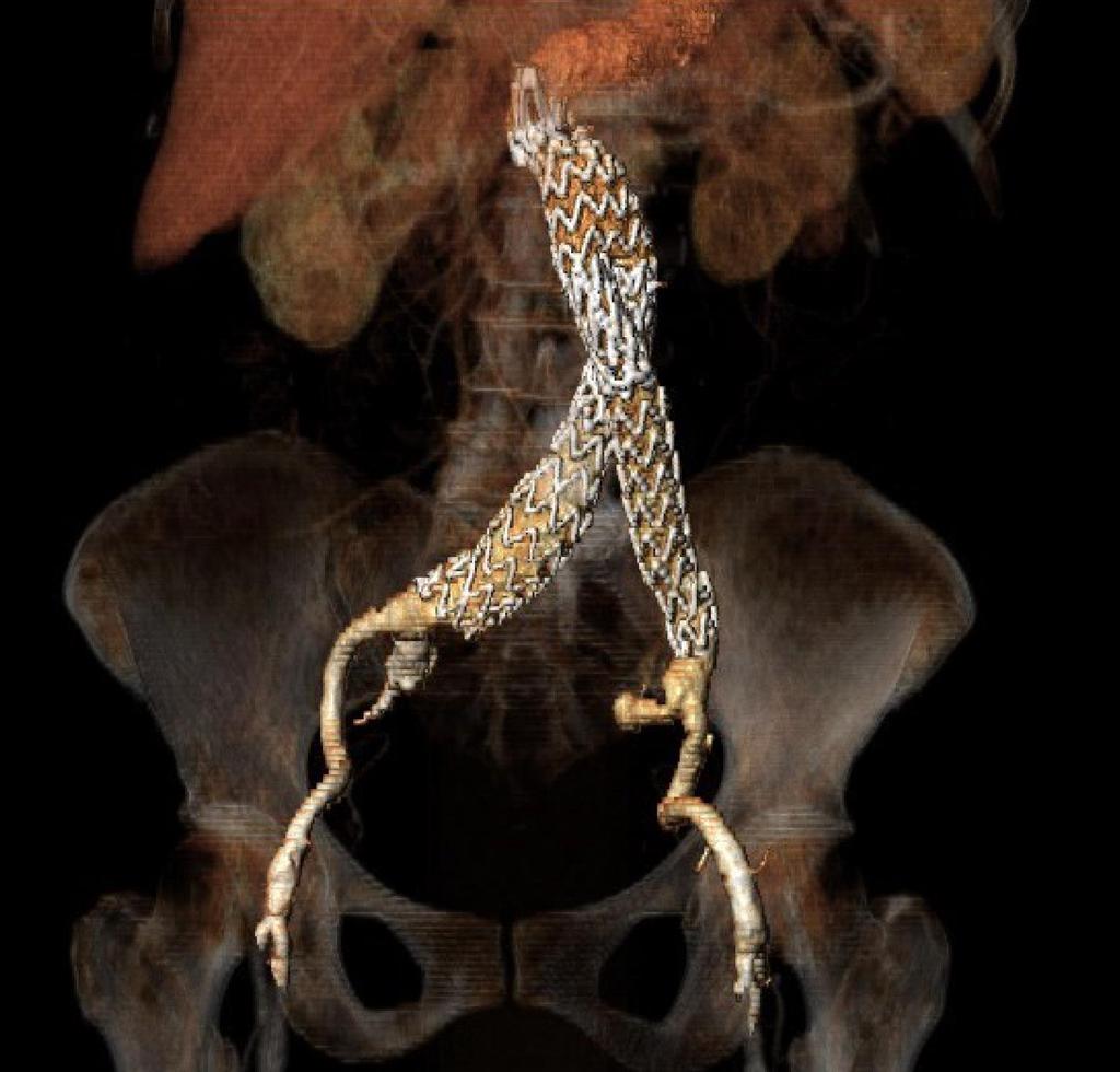 Case Example Initial Films Acute Infrarenal Angle/Suprarenal Angle Fairly Long Neck Within the Angulated Segment Endurant IIs Deployed Below the Renals Could Not Gain More Height Flared Limbs Within