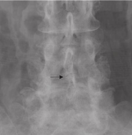 Spine Injections and Kissing Spine Disease Fig. 3. PA radiograph of the lumbar spine demonstrating very closely approximated L4 and L5 spinous processes (arrow). Fig. 4.