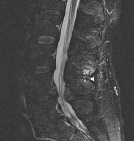 formation in the inferior L3 and superior L4 spinous process. CASE 3 A 71-year-old male presented with a greater than one year history of focal midline, non-radicular low back pain.