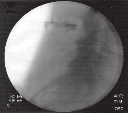 ture of his pain relief, the patient elected to proceed with surgical resection of the L3 and L4 spinous processes. His pain resolved at 6 weeks follow-up. INJECTION TECHNIQUE Fig. 8.