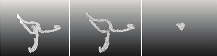 Figure 5. Volume rendering of an automatic segmentation result (left) and aneurysm (right) separated from surrounding vessels (middle) for evaluation purposes.