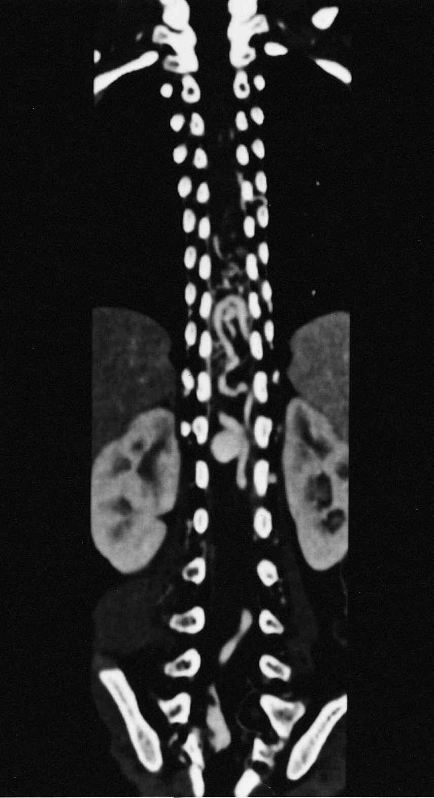Interventional Neuroradiology 8: 37-44, 2002 0.015 CTD (Balt Company, Paris, France) and glue embolization was performed with 1 cc of Histoacryl, 0.8 cc of Lipiodol, and 0.5 g of Tantalum powder.