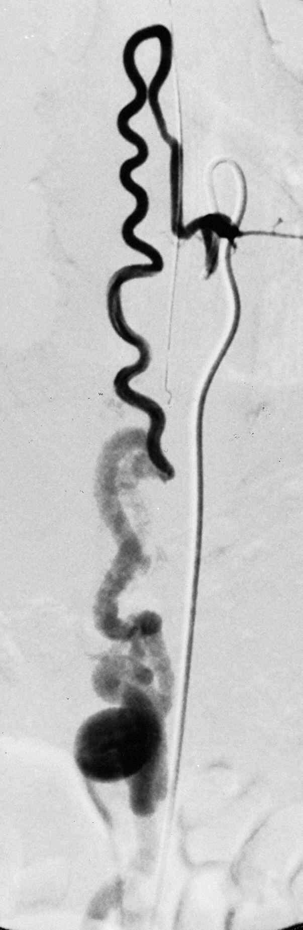 fistula. B) Left 7 th intercostal arteriography shows radiculo-medullary artery connecting to a single hole fistula.at the ventral surface of spinal cord at th elevel Th10.