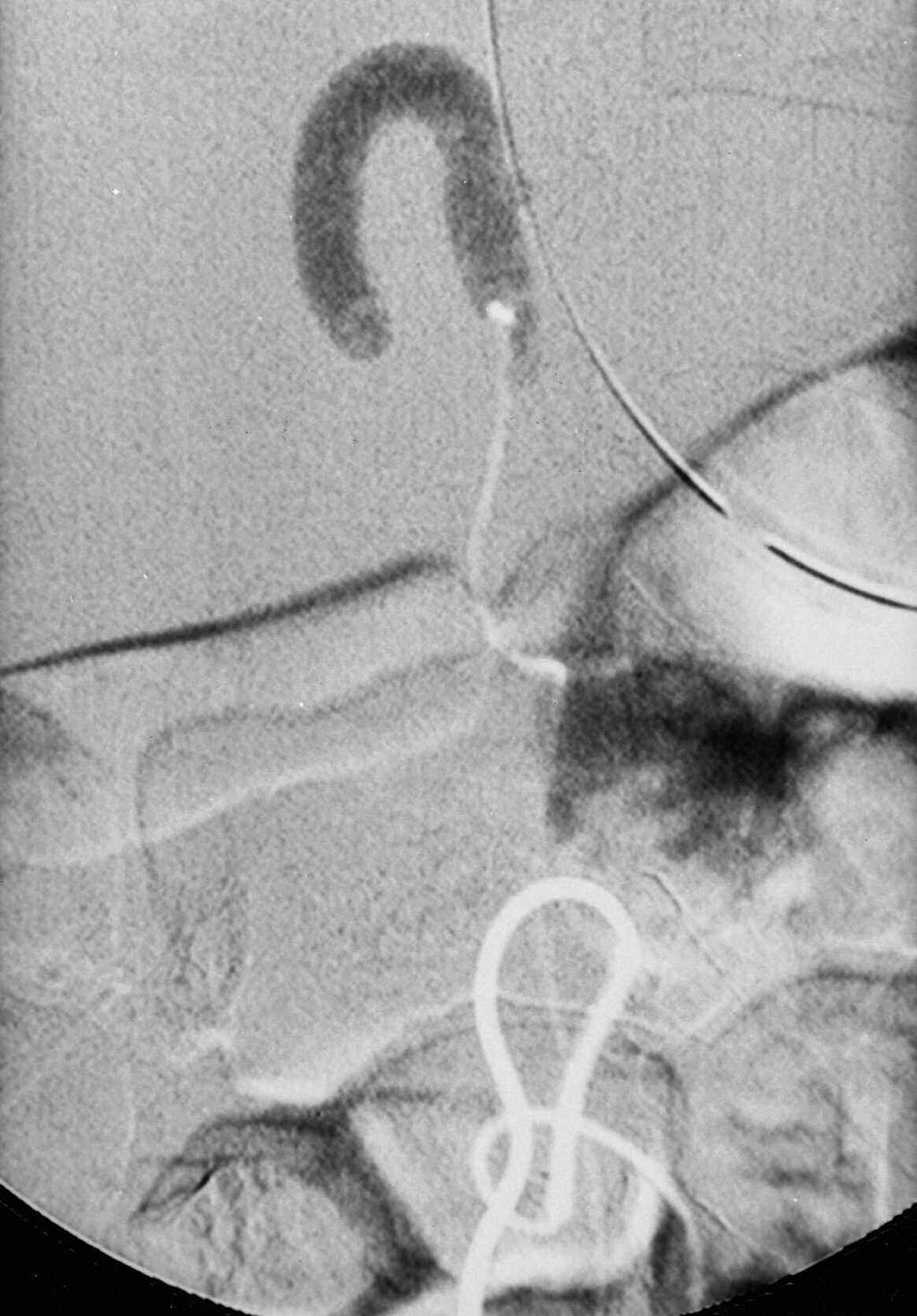 E) Glue embolization closes the shunt between multifeeders and single-hole fistula. and difficult management problems.