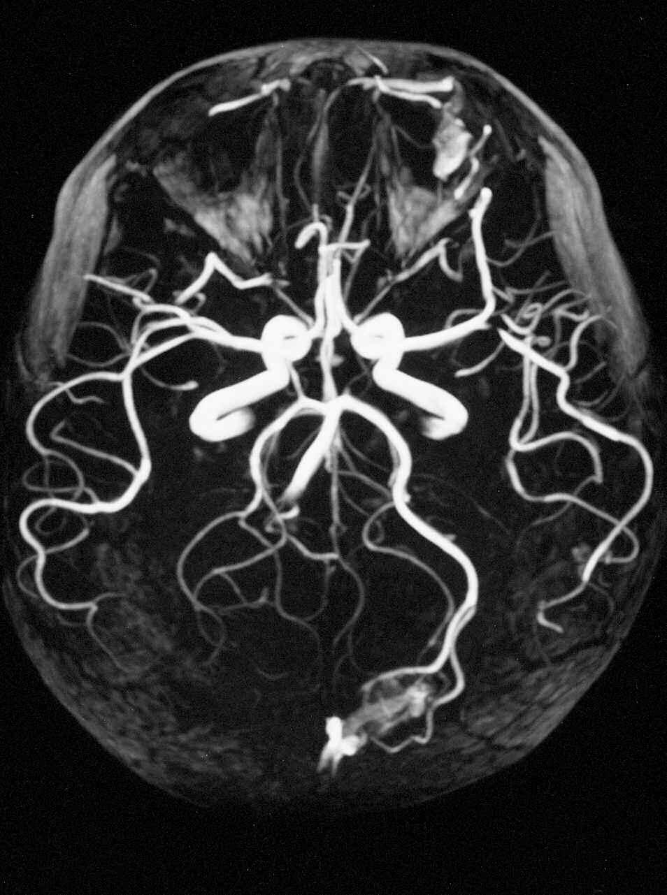 Interventional Neuroradiology 8: 37-44, 2002 tary occurrence, while more recent literature has shown a widespread angiodysplasia associated with this syndrome.