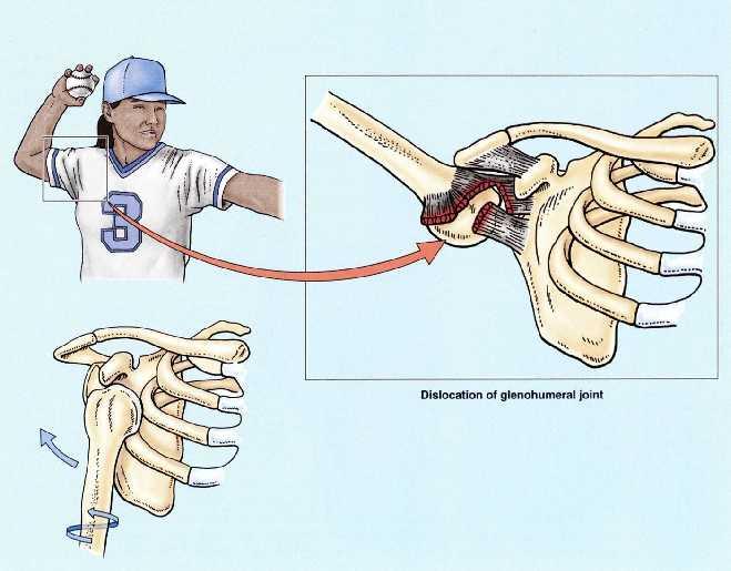 DISLOCATIONS OF THE SHOULDER JOINT The shoulder joint is the most commonly dislocated