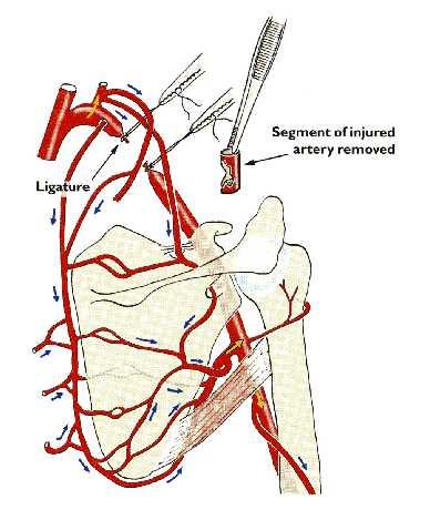LIGATION OF THE AXILLARY ARTERY The existence of the anastomosis around the shoulder joint is
