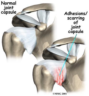 Adhesive Capsulitis Defined by AAOS as a condition of varying severity characterized by the gradual development of global limitation of active and passive
