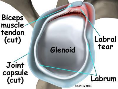 Labral Tears Labrum is part of cartilaginous ring that extends anterior and posterior to the biceps insertion Helps with the depth of the shallow glenoid increases humeral head contact
