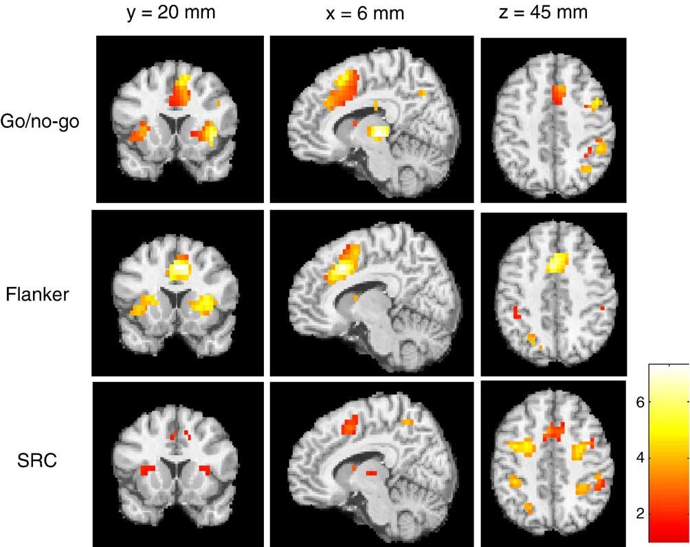 328 T.D. Wager et al. / NeuroImage 27 (2005) 323 340 Fig. 1. Slices showing activations in each task: go/no-go (top row), flanker (middle row), and stimulus response compatibility (bottom row).