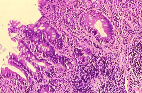 Active chronic gastritis with intestinal metaplasia as seen with Helicobacter pylori. Goblet cells (black arrows) are not normally seen in the gastric epithelium.